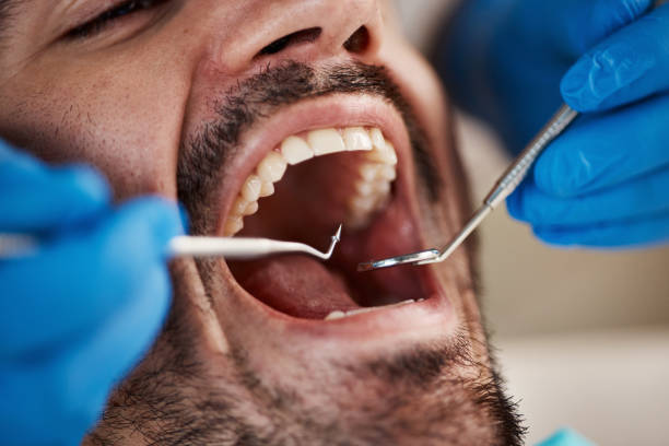 Best Emergency Dentist for Lost Fillings or Crowns in Monticello, GA